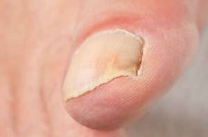 toenail fungus cured